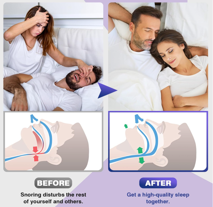 Anti Snoring Ring Device